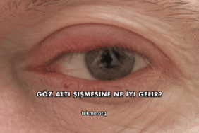 Göz Altı Şişmesine Ne İyi Gelir?