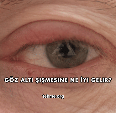 Göz Altı Şişmesine Ne İyi Gelir?