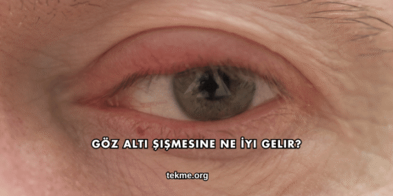 Göz Altı Şişmesine Ne İyi Gelir?