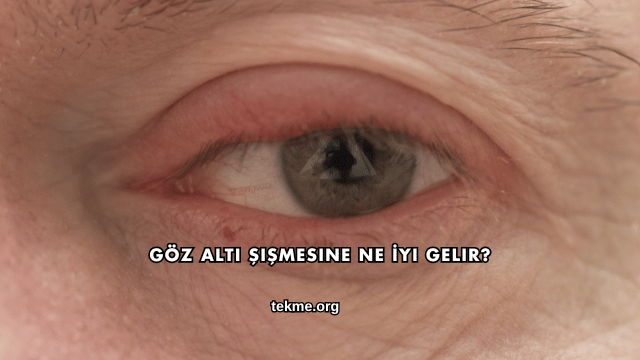 Göz Altı Şişmesine Ne İyi Gelir?