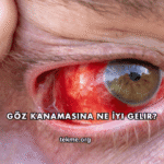 Göz Kanamasına Ne İyi Gelir?