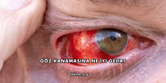 Göz Kanamasına Ne İyi Gelir?