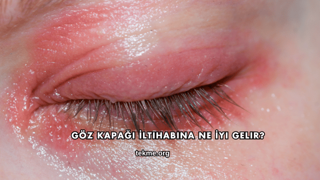 Göz Kapağı İltihabına Ne İyi Gelir?