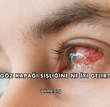 Göz Kapağı Şişliğine Ne İyi Gelir?
