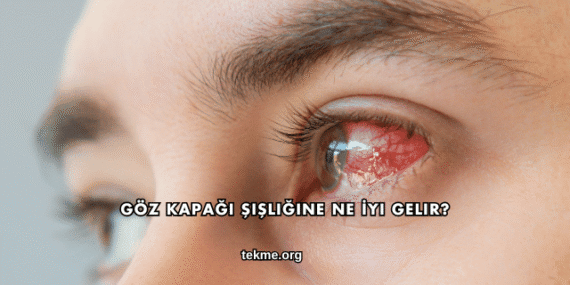 Göz Kapağı Şişliğine Ne İyi Gelir?
