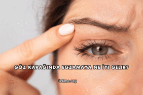 Göz Kapağında Egzamaya Ne İyi Gelir?
