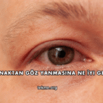 Kaynaktan Göz Yanmasına Ne İyi Gelir?