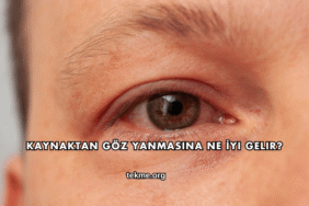 Kaynaktan Göz Yanmasına Ne İyi Gelir?