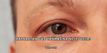 Kaynaktan Göz Yanmasına Ne İyi Gelir?