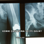 Kemik Çatlağına Ne İyi Gelir?