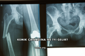 Kemik Çatlağına Ne İyi Gelir?