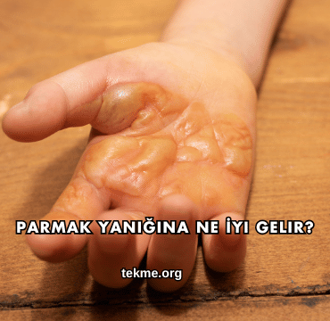 Parmak Yanığına Ne İyi Gelir?
