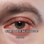 Şişmiş Göze Ne İyi Gelir?