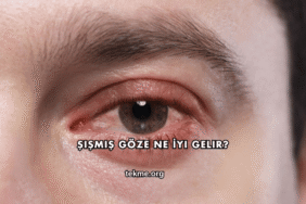 Şişmiş Göze Ne İyi Gelir?