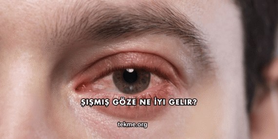 Şişmiş Göze Ne İyi Gelir?