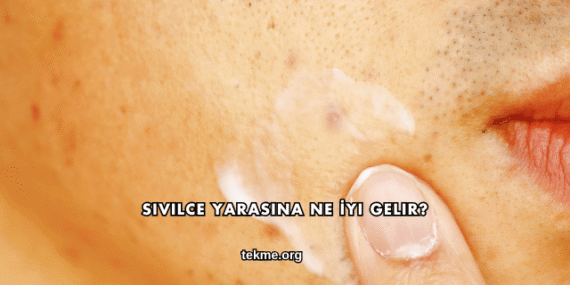 Sivilce Yarasına Ne İyi Gelir?