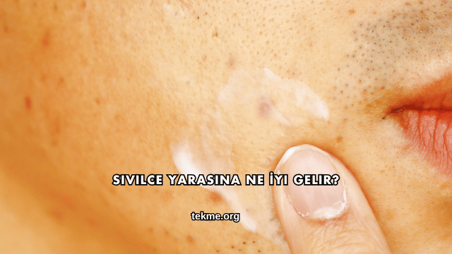 Sivilce Yarasına Ne İyi Gelir?