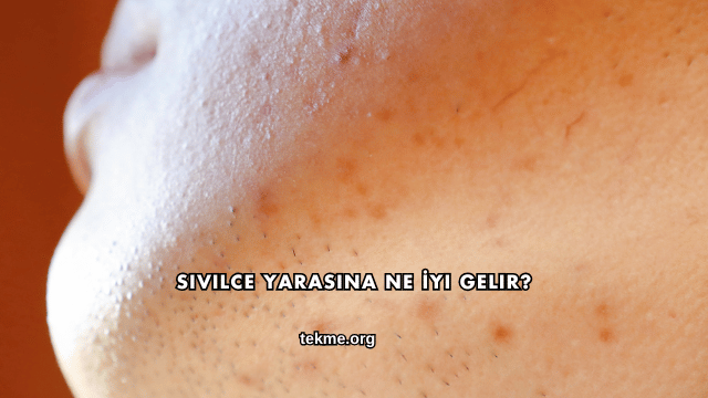 Sivilce Yarasına Ne İyi Gelir?