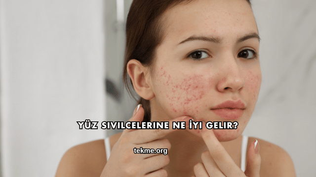 Yüz Sivilcelerine Ne İyi Gelir?