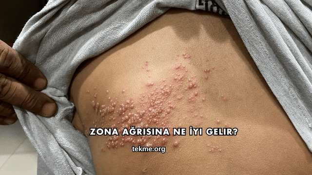 Zona Ağrısına Ne İyi Gelir?